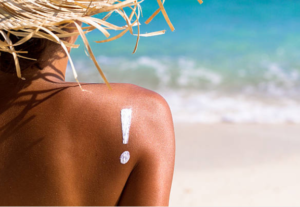 Sunburn